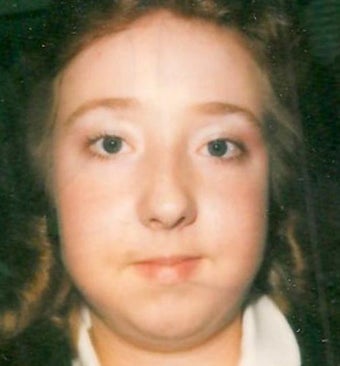 Rhinoplasty before 355873