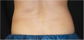 CoolSculpting after 421631