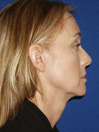 Cheeklift (Minifacelift), Bilateral Upper Blepharoplasty, Periorbital TCA Chemical Peel, Soft Tissue Filler to Nasolabial Folds before 249153