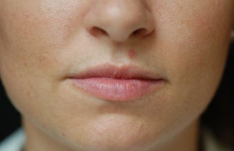 Juvederm Lip Augmentation before 624796