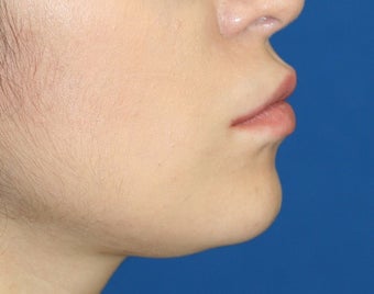 Lip Reduction after 250836