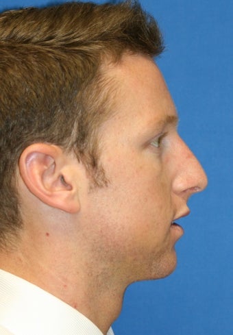Rhinoplasty after 223264