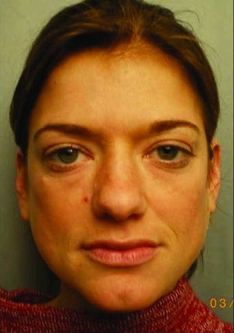 Radiesse injections before 349807