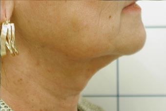 SmartLipo after 141872