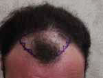 Hair Transplant before 426684