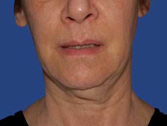 Jawline / Neck Lipo before 565723