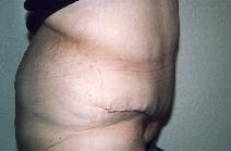 Body Contouring after 557014