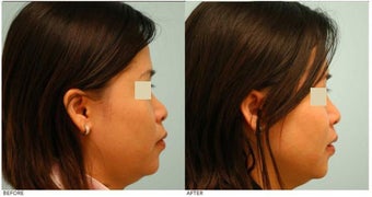 Dallas Asian Rhinoplasty after 136821