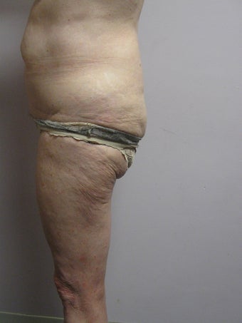 Lateral Thigh Lift before 389759