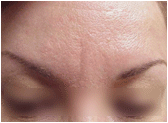 Botox after 267538