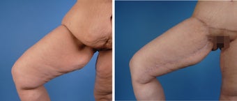 Thighplasty after 335987