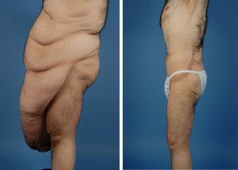 Body Lift after 335979