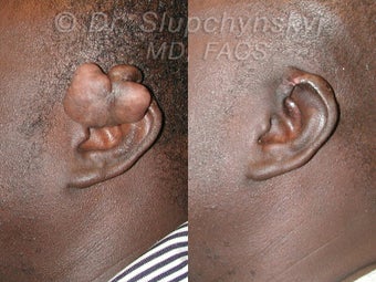 Keloid Removal after 563856
