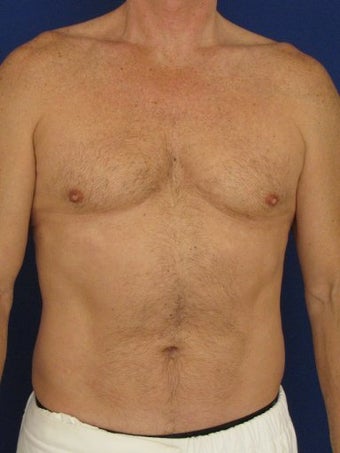 Vaser Hi Def Liposuction of chest, abdomen, back and flanks before 422687