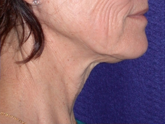 Necklift 208444