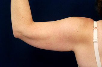 Liposuction - Upper Arms 393164