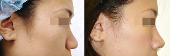 Rhinoplasty before 650748