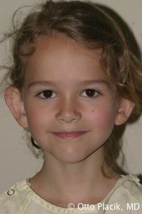 Otoplasty before 567524