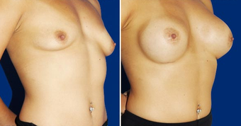 Breast Implants after 494492