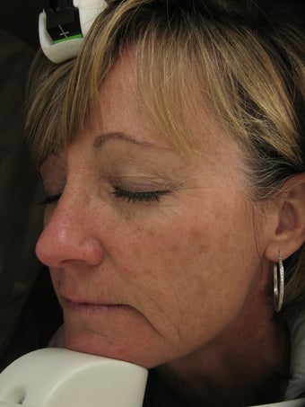 Fraxel re:pair CO laser resurfacing for fine lines and pigmentation before 121890