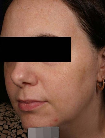 Melasma after 136699