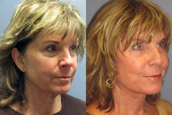 Lite Lift, Brow Lift, Neck Lift, Eyelid Lift, Blue Peel before 523329