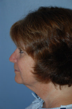 Neck Lift before 265847