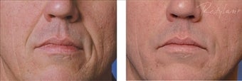 Restylane before 110127