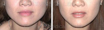 Jaw before 431335