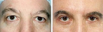 Belpharoplasty before 643228