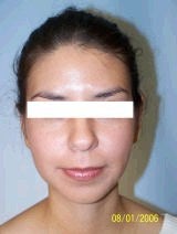 Ear Surgery (Otoplasty) after 357655