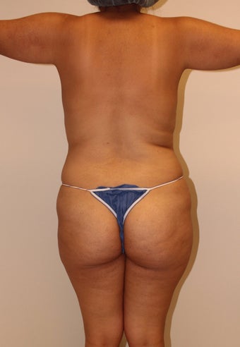 Brazilian butt lift 360623