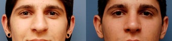 Rhinoplasty, Ethnic Iranian after 346238