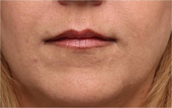Restylane 444317