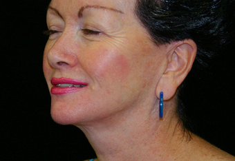Facelift after 238515