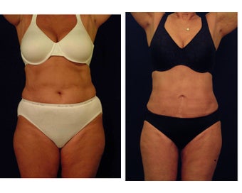 Liposuction before 397053