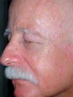 PDT for rosacea after 376140