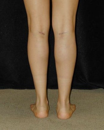 Calve Implants - Posterior View after 214655