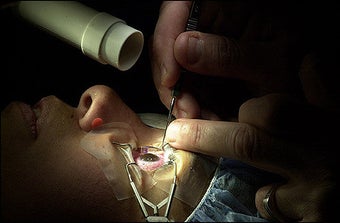 Lasik surgery before 87376