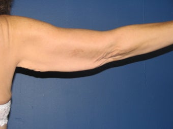 Brachioplasty before 575816