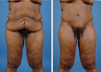 Lower Body Lift with Laser Liposuction to the Hips and Thighs before 335995