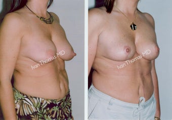 Mastopexy-Breast Lift before 243724