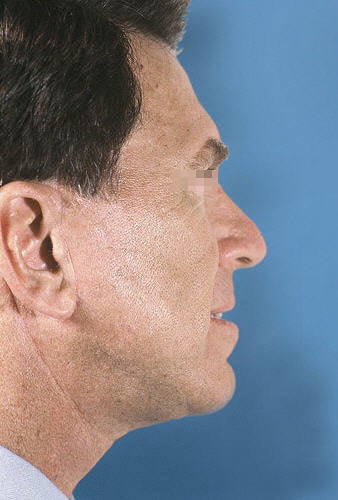 Facelift for Men after 114163