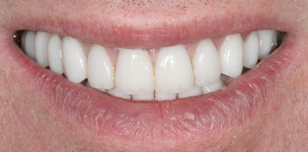 Porcelain veneers and crowns after 503136
