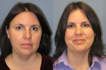 Lite Lift™, liposuction of the neck after 523705