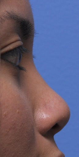Non Surgical Rhinoplasty before 307850