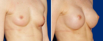 Breast Implants after 494487