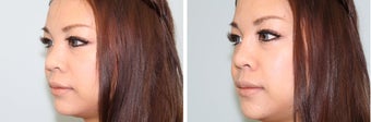 Nasal filler 577824