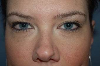 Restylane used in tear trough after 427909