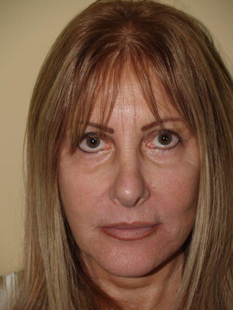Revision Rhinoplasty 303872